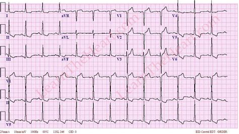 lvh strain pattern|lvh with strain ekg.